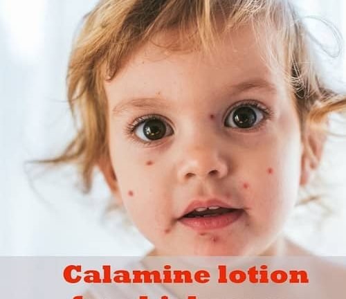 Review of calamine lotion for chickenpox
